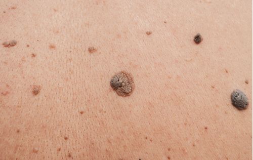 Moles on a persons back ready to be checked for possible skin cancer treatment options